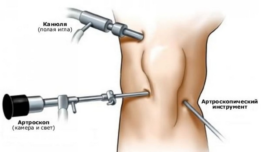 Хірургічне лікування проводять з відкритого доступу або за допомогою ендоскопічної артроскопії