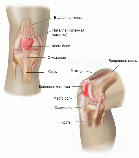 Якщо ви відчуваєте тягне біль над колінної чашечкою або взагалі в коліні, яка посилюється при підйомах і спусках по горбах і сходах або при сидінні з підігнутими ногами, причиною може бути пателлофеморальний больовий синдром