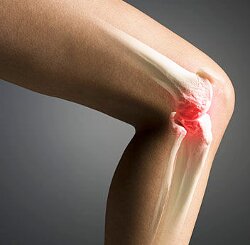 Артроз колінного суглоба, також відомий як гонартроз, поширений недуга не запального характеру, який вражає хрящову тканину коліна, тягне його деформацію, і як наслідок знижує рухливість людини в загальному
